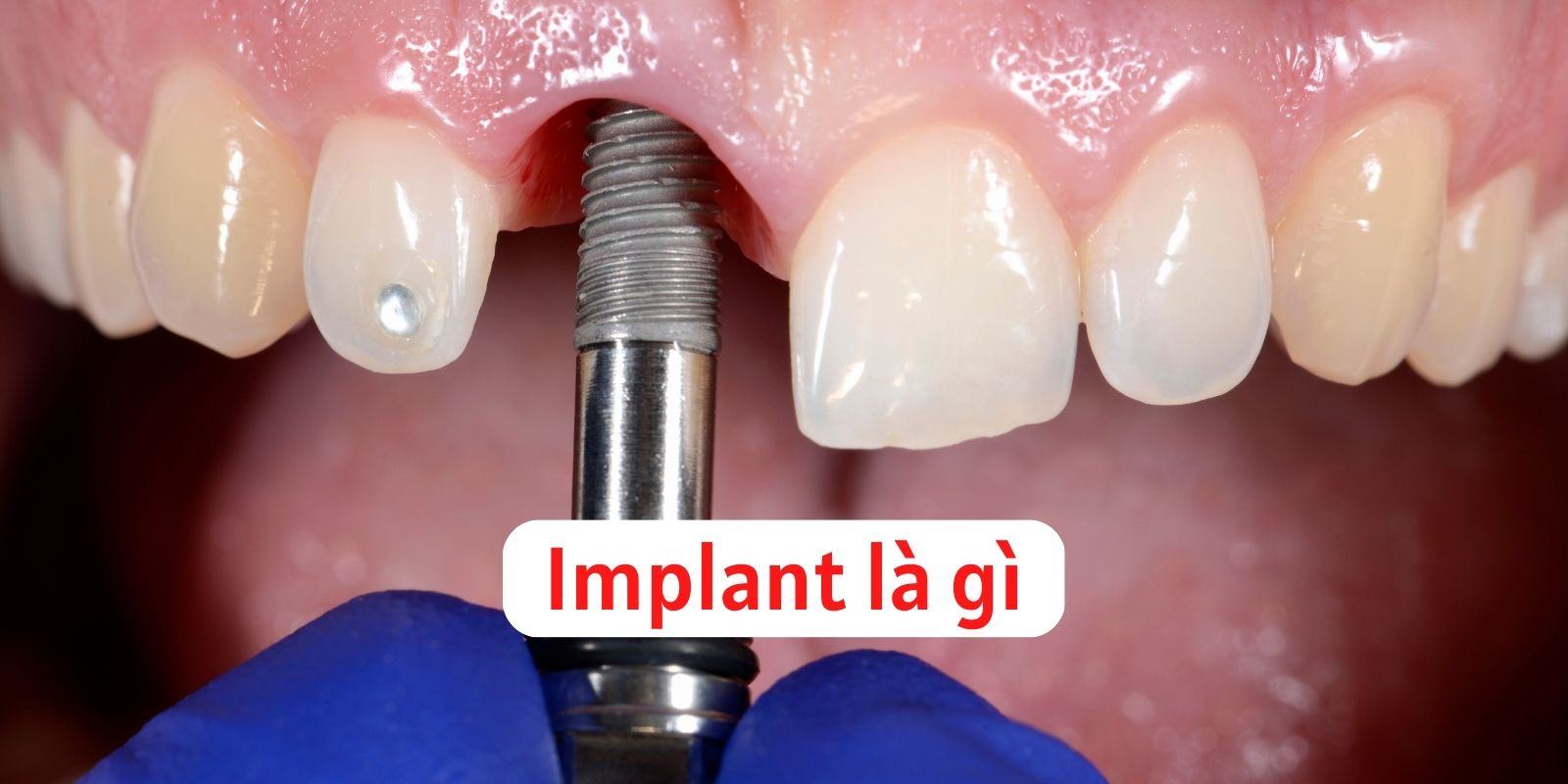 Implant là gì?  Cấy ghép nha khoa là một thuật ngữ liên quan