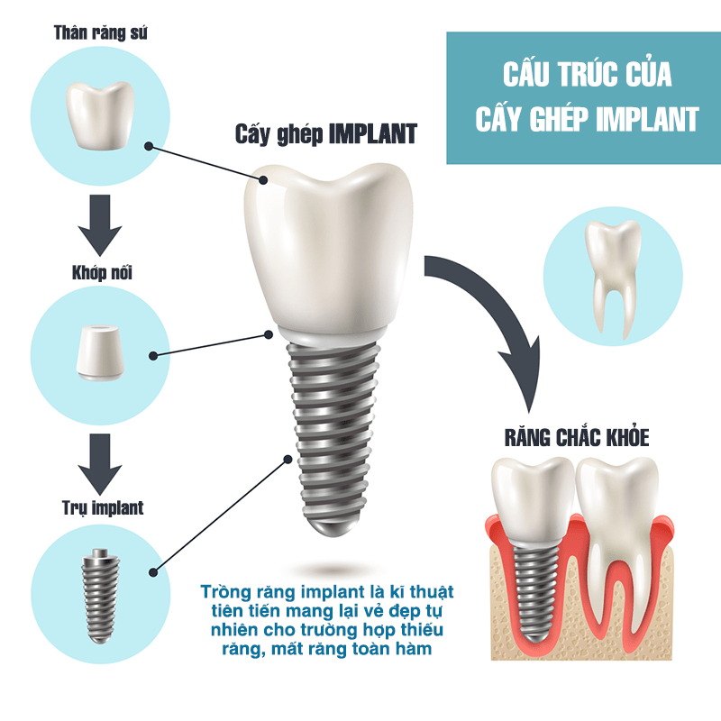 Cấy ghép nha khoa cảm thấy như thế nào?